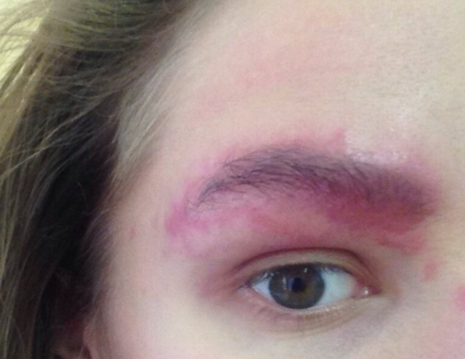 Аллергическая реакция