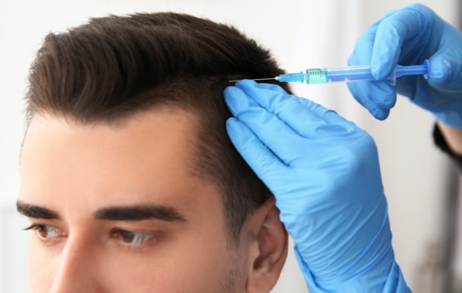 мезотерапия при облысении