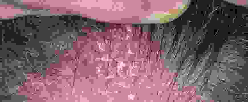 Псориаза на голове - симптомы